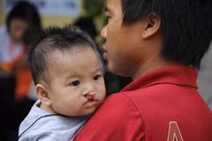 Cleft lip, palate surgeries offered free of charge