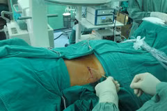 HCM City surgeons remove giant kidney stone