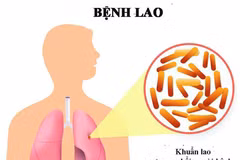 PM calls to boost anti-tuberculosis efforts