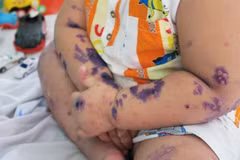 HCM City sees surge in hand, foot and mouth infections