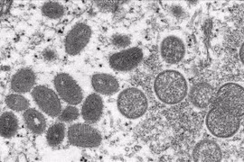 Efforts made to prevent monkeypox from spreading