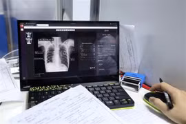 Campaign calls for youth engagement in TB fight