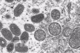 Vietnam yet to record monkeypox cases, but high risk projected 