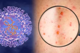 Ministry preparing response plans for monkeypox