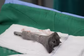 Cho Ray Hospital successfully applies new technique in bone surgery