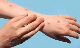 Thailand detects mpox infection in tourist