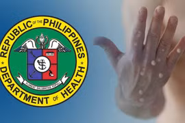 The Philippines reports more Mpox cases (Photo: asianews.network)