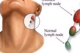 About 2,700 new cases of lymphoma in people of all ages are detected in Vietnam each year, but it occurs most commonly in middle age (Photo: suckhoedoisong)