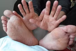 Experts concern over virus Enterovirus 71