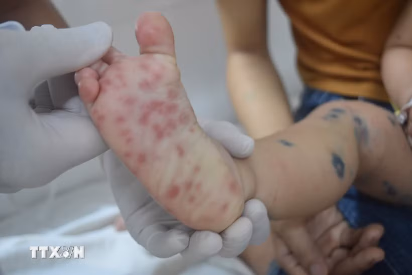 Most infections were reported among children under 10 years old, making up 99.3%, with those aged 1–5 accounting for the highest proportion (92.7%). (Illustrative photo: VNA)
