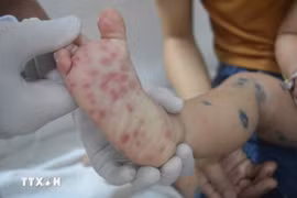 Most infections were reported among children under 10 years old, making up 99.3%, with those aged 1–5 accounting for the highest proportion (92.7%). (Illustrative photo: VNA)