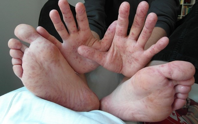 Experts concern over virus Enterovirus 71 ảnh 1 Experts concern over virus Enterovirus 71 ảnh 1
