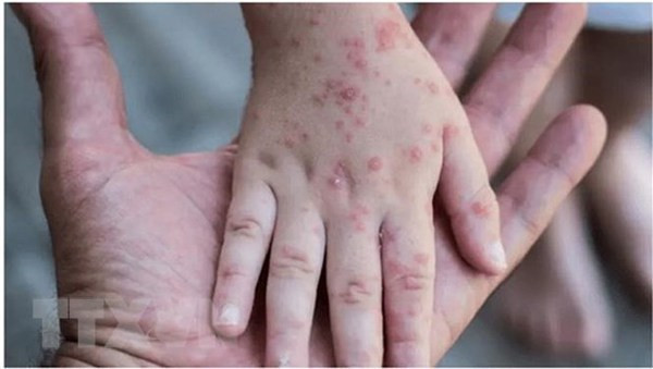 WHO to continue to support Vietnam in monkeypox prevention, response: Representative ảnh 2