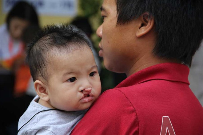 Cleft lip, palate surgeries offered free of charge ảnh 1 Cleft lip, palate surgeries offered free of charge ảnh 1
