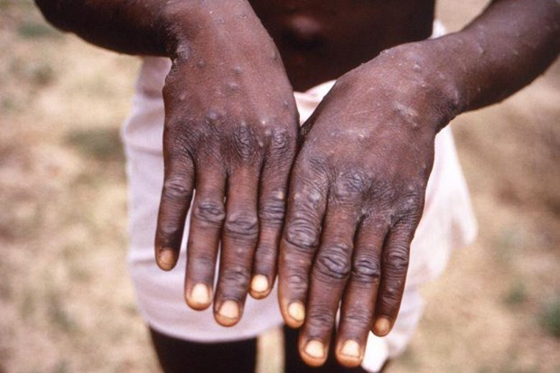 Singapore detects first case of rare monkeypox ảnh 1 Singapore detects first case of rare monkeypox ảnh 1