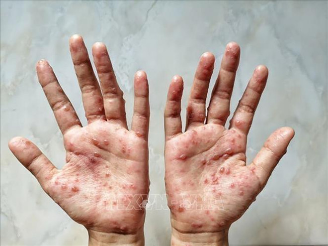Laos detects first monkeypox case ảnh 1