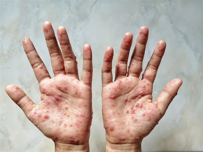 Cambodia logs 12 cases of monkeypox ảnh 1 Cambodia logs 12 cases of monkeypox ảnh 1