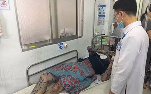 City export zone reports outbreak of chickenpox ảnh 1