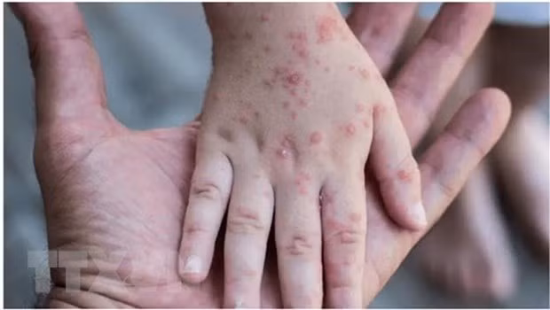 Vietnam prompted on monkeypox readiness measures ảnh 1