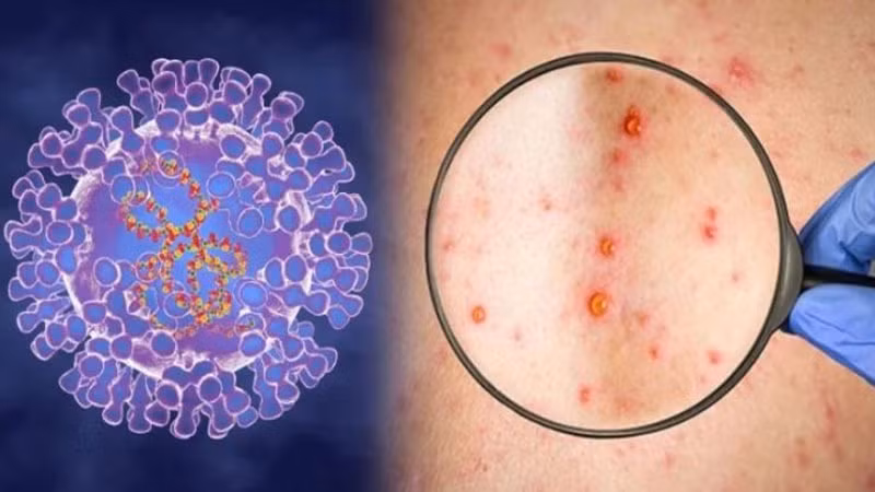 HCM City reports another case of monkeypox ảnh 1