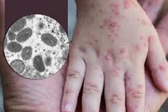 Monkeypox put under control in Vietnam 
