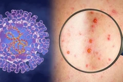 Ministry preparing response plans for monkeypox