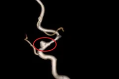 Doctors warn of stroke risks for children