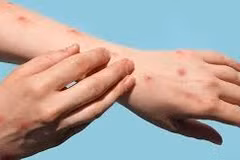 Thailand detects mpox infection in tourist