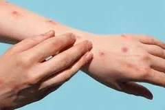 Thailand detects mpox infection in tourist