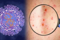 HCM City reports another case of monkeypox