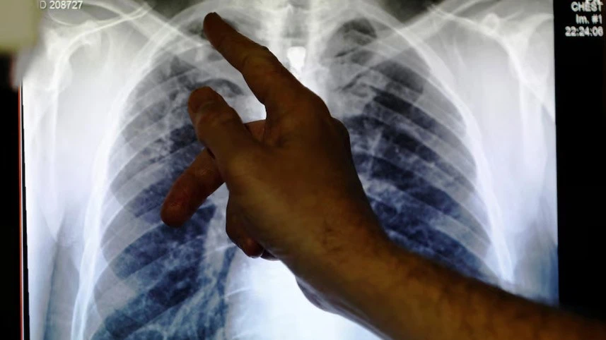 Malaysia urges public to step up tuberculosis prevention