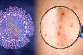 HCM City reports another case of monkeypox