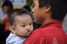Cleft lip, palate surgeries offered free of charge