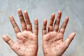 Cambodia logs 12 cases of monkeypox