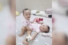 HCM City doctors separate conjoined twins