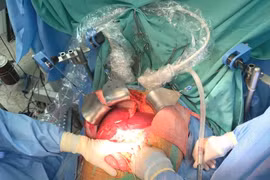 Hue Central Hospital performs record number of organ transplants