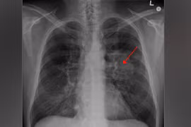 Lung cancer patients in Indonesia surge