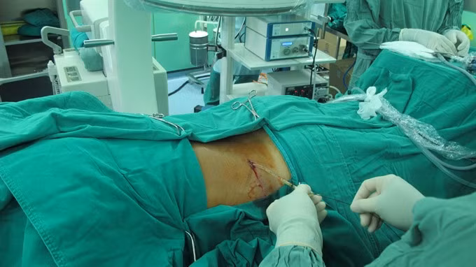 HCM City surgeons remove giant kidney stone ảnh 1
